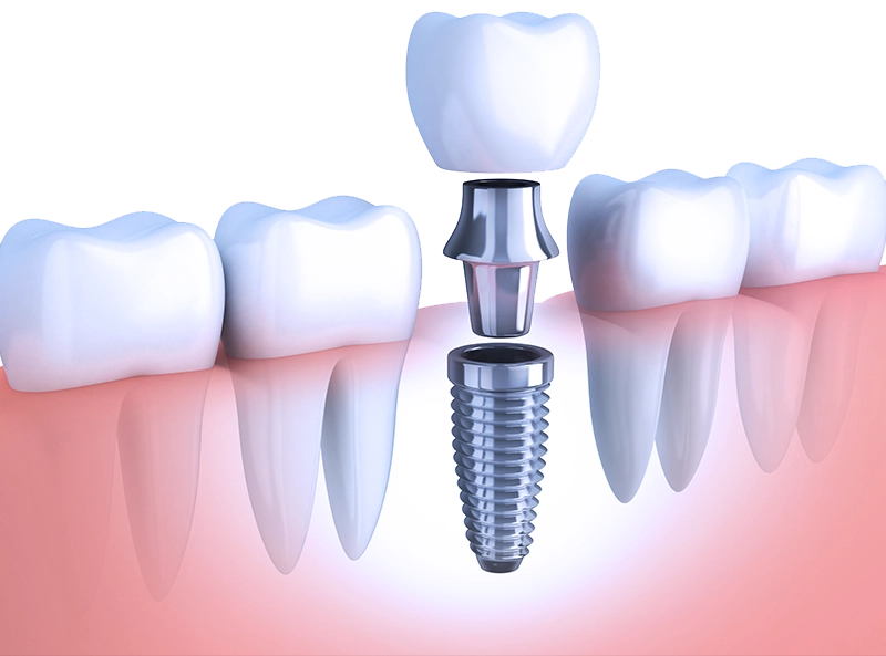Dental Implants 3D