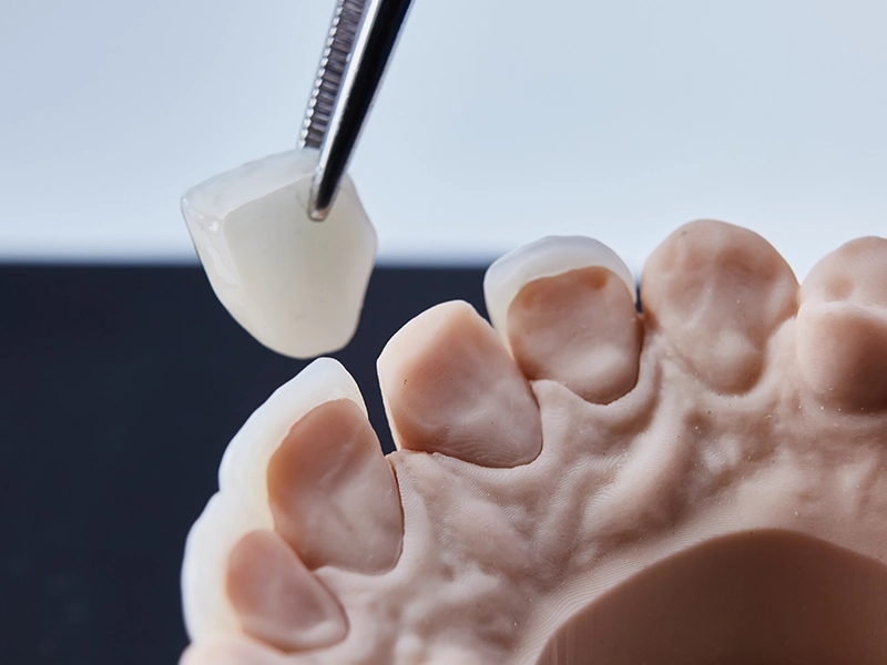 CEREC Veneer Process