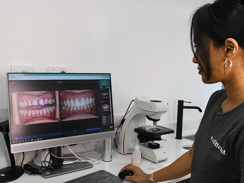 veneers and contouring